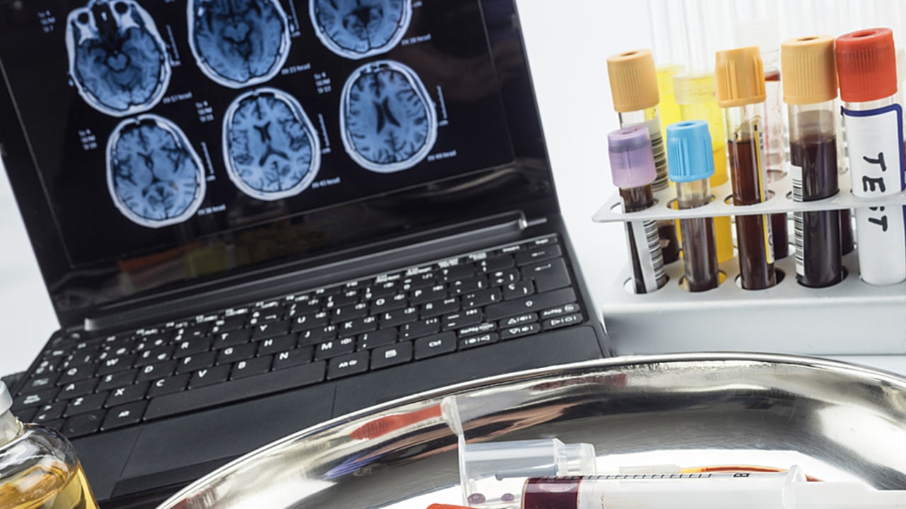 L'un des défis actuels réside dans le diagnostic précoce, alors que les biomarqueurs permettent désormais de décrire l'avancée de la maladie. (SPL/BSIP)