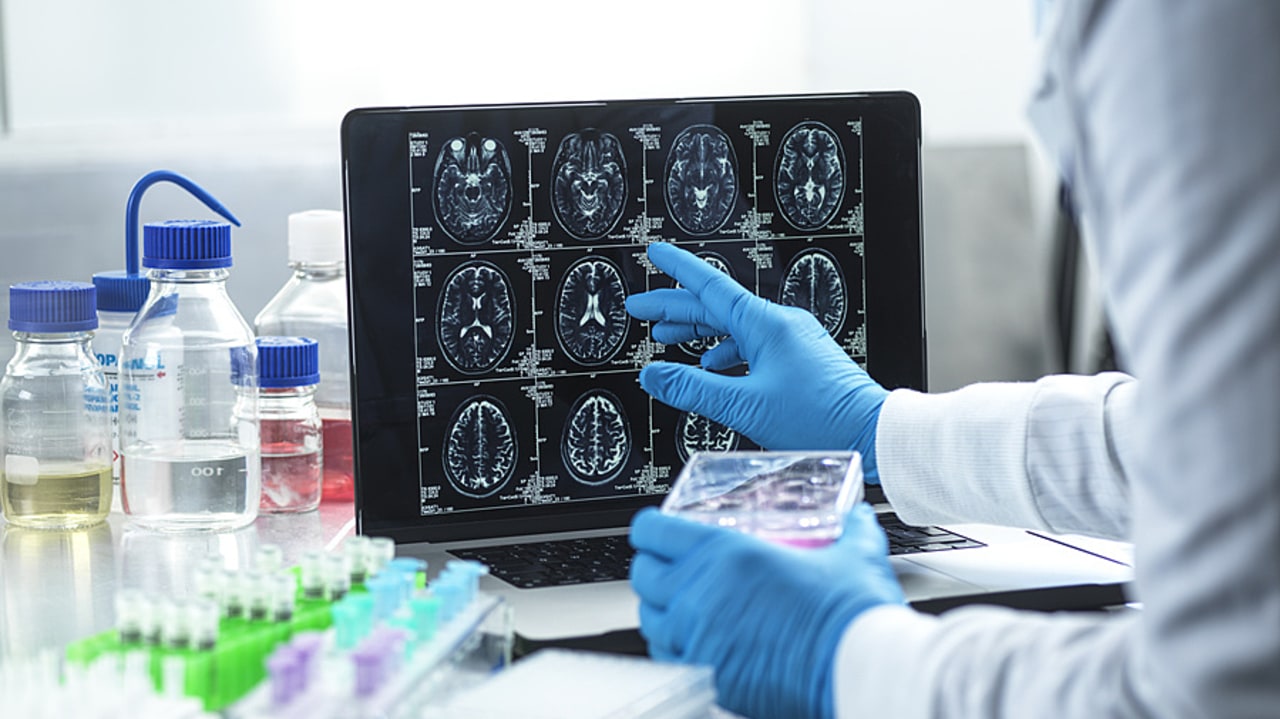 Un meilleur accès aux neurologues et donc au diagnostic ne suffit pas toujours à expliquer la hausse de la prévalence. (SPL/BSIP)
