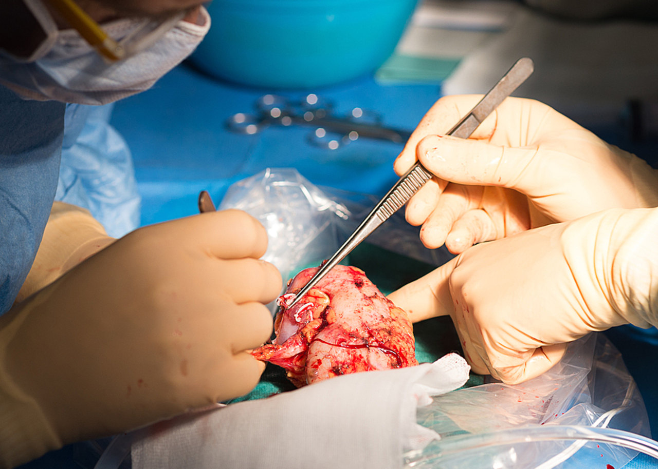 La réforme des astreintes est jugée délétère pour les équipes de greffes