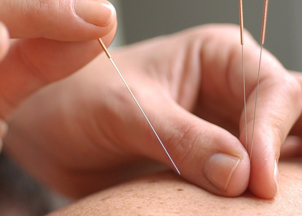 La Miviludes rappelle que les formations de développement personnel ou de bien-être des personnels doivent faire l'objet  d'une attention particulière. La pratique de l'acupuncture est réservée uniquement aux médecins et aux sages-femmes. (Voisin/Phanie)