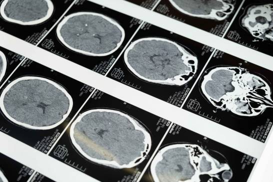 Investigadores españoles identifican microtrombos en Alzheimer con técnica no invasiva