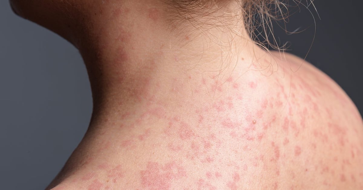 Public health alert issued for measles exposure in Nanaimo area