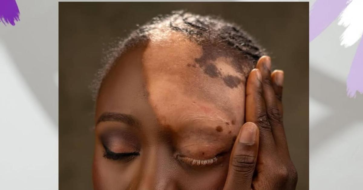 Nigerian woman advocates for vitiligo awareness after relationship struggles