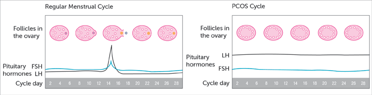 regular-vs-pcos-menstrual-cycle