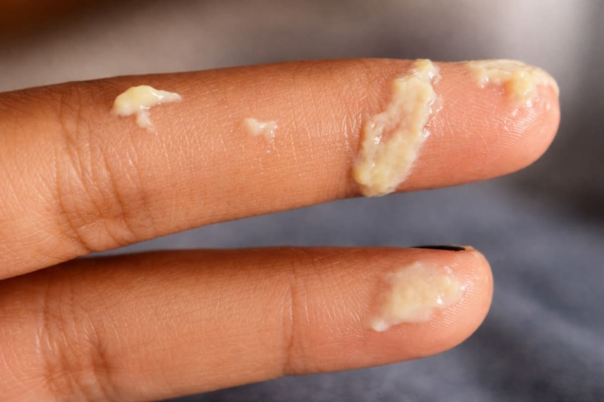 yeast-infection-1 yeast-infection-1