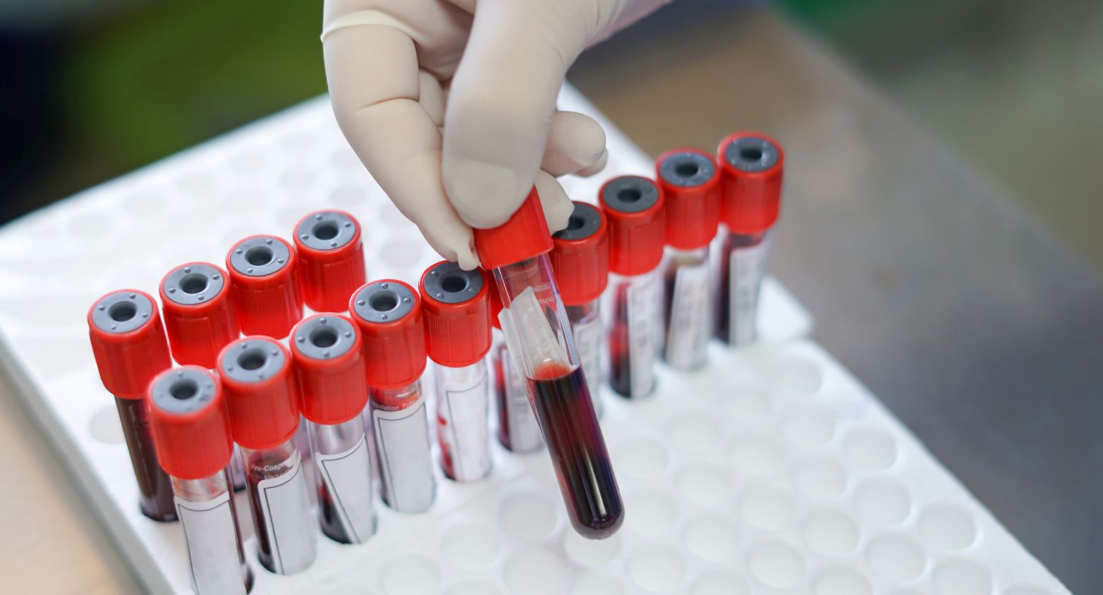 several blood samples in different tubes