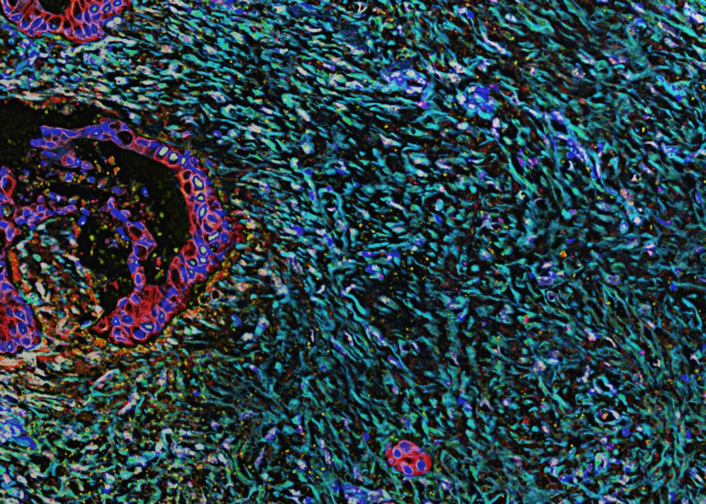 Singularityhub reports AI is used to accelerate discovery of drugs targeting previously undruggable cancers.