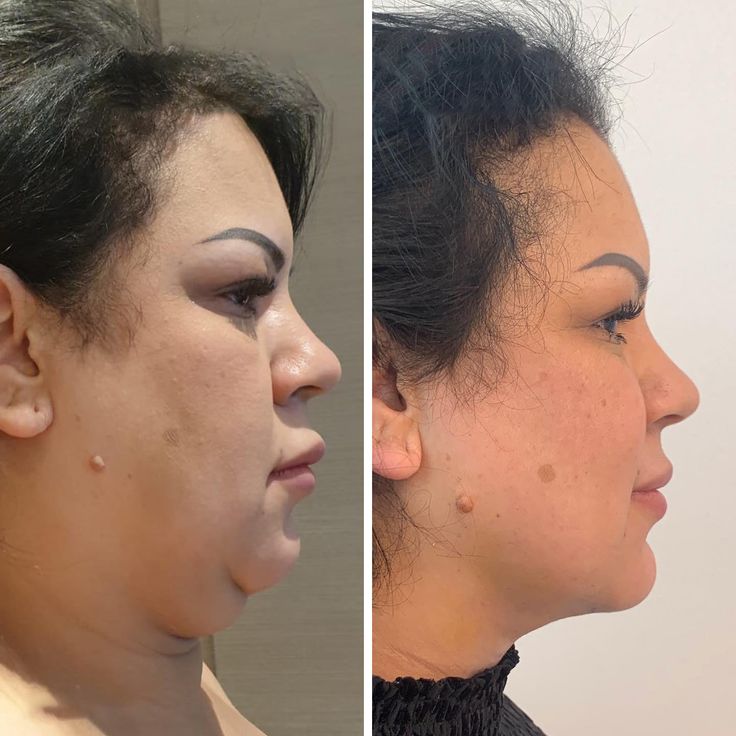 Double Chin Liposuction