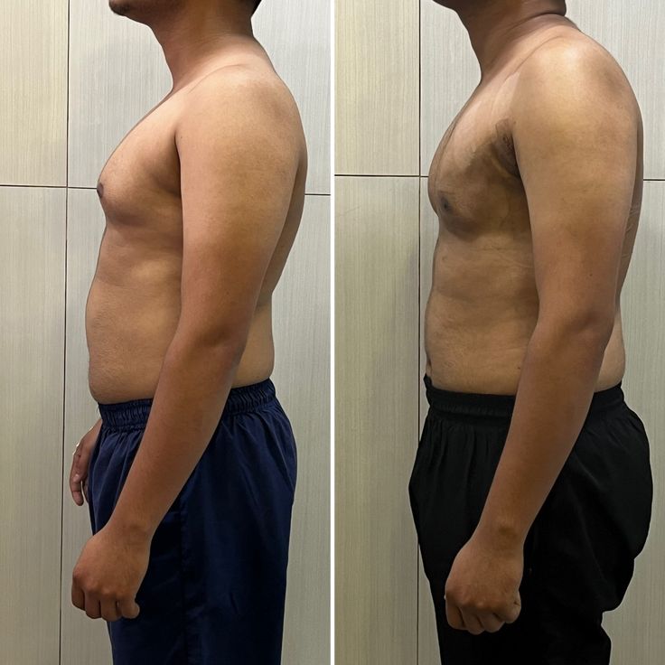 Gynecomastia Surgery