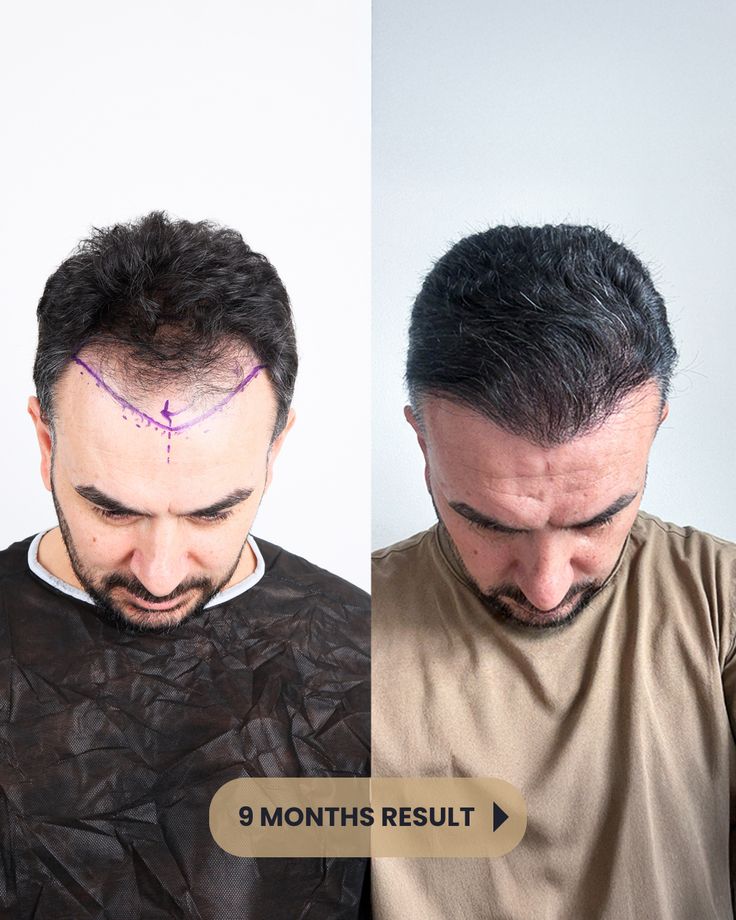 Hair Transplant