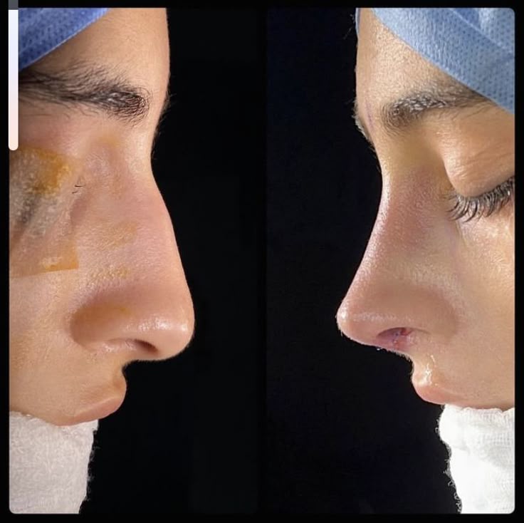 Rhinoplasty
