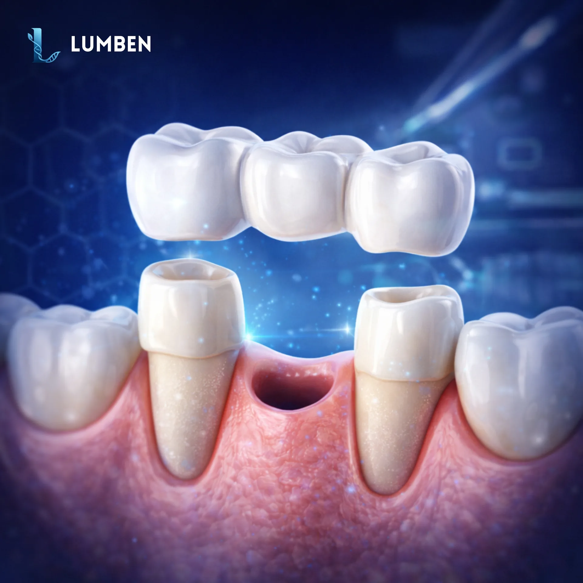 Dental Bridge Treatment