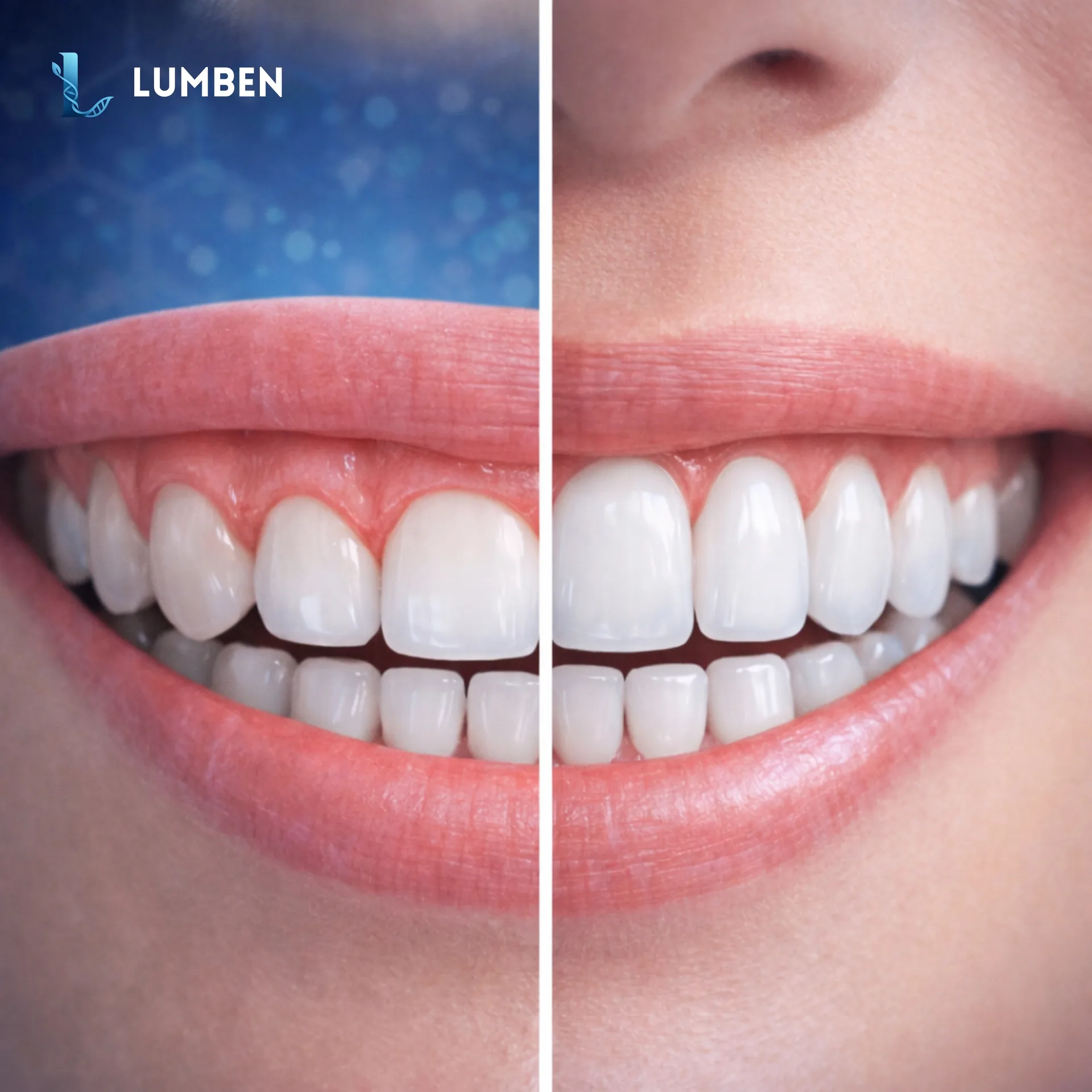 Gum Contouring (Gummy Smile Treatment)