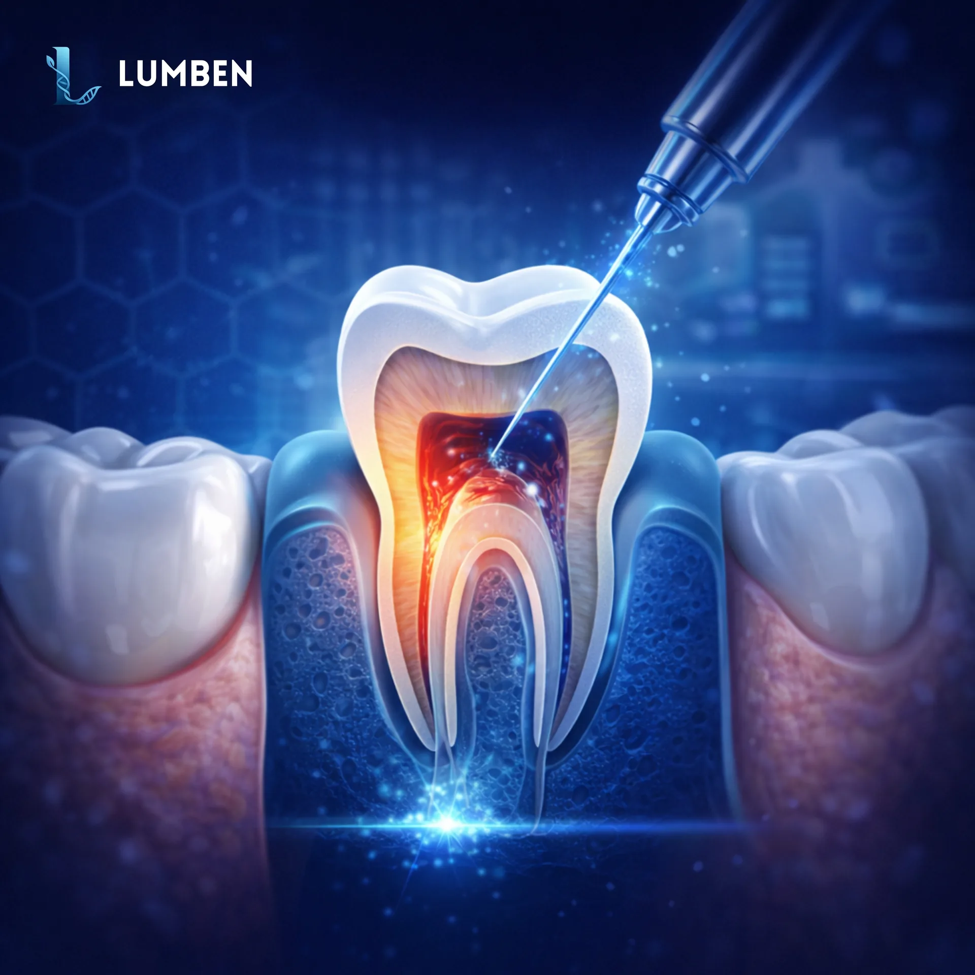 Root Canal Treatment