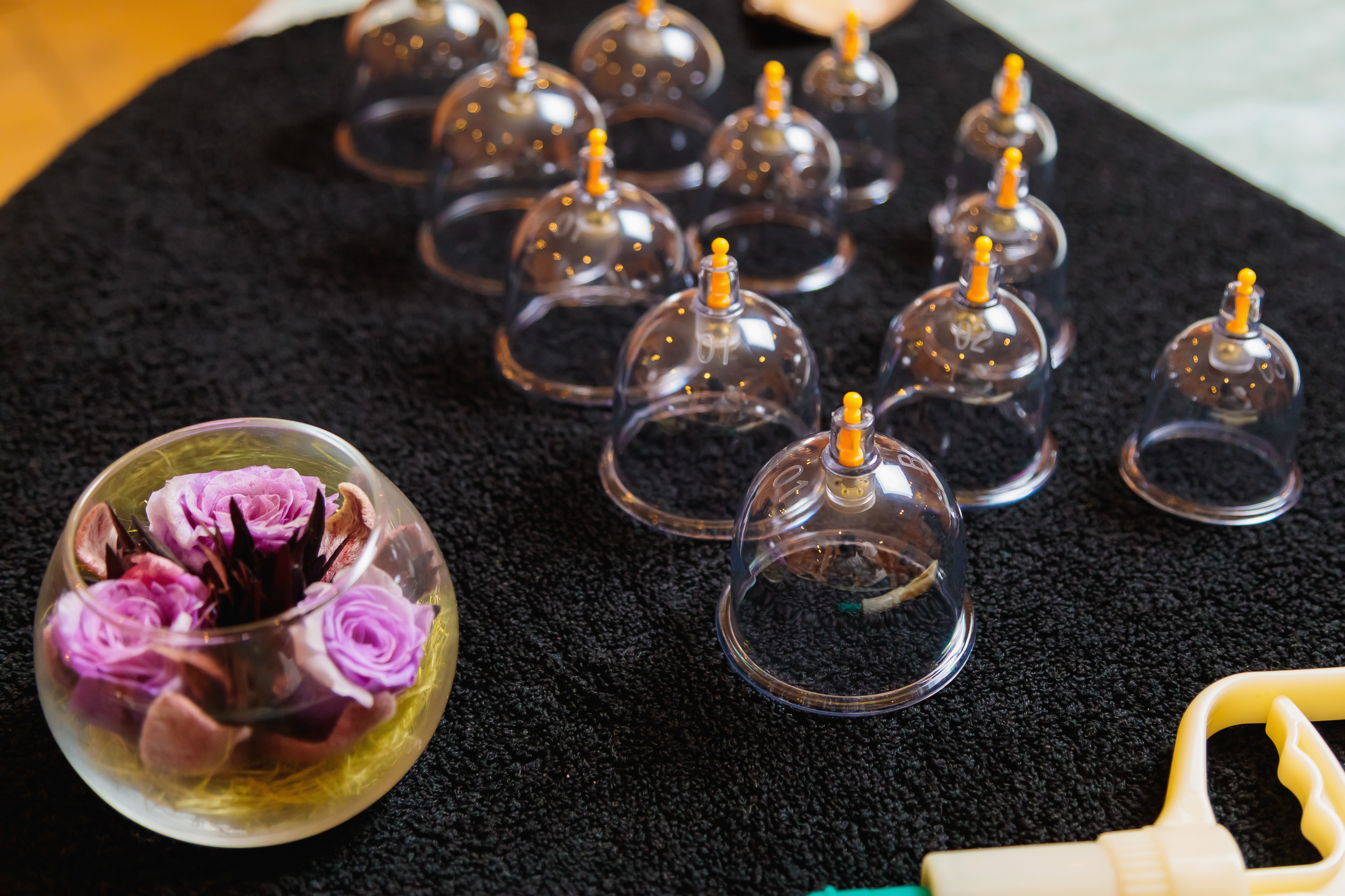 The Impact of Hijama (Cupping Therapy) on Blood Circulation and Cholesterol