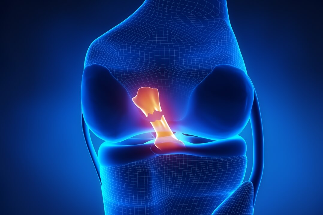ACL Injuries: Rehab Protocols and What to Expect
