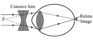 Correction of shortsightedness