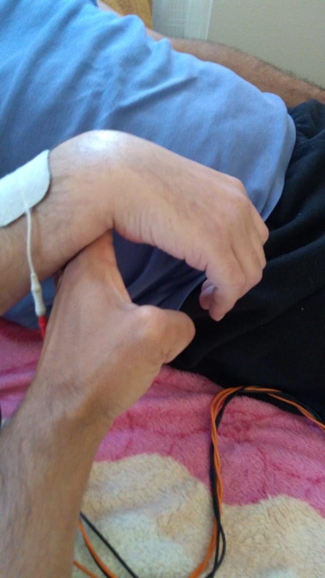 O que é a rigidez depois do AVC? A fisioterapia ajuda?