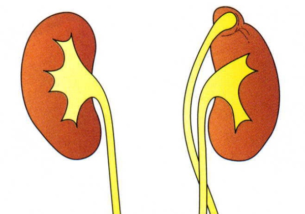 Раздвоение почки у ребенка что это такое фото