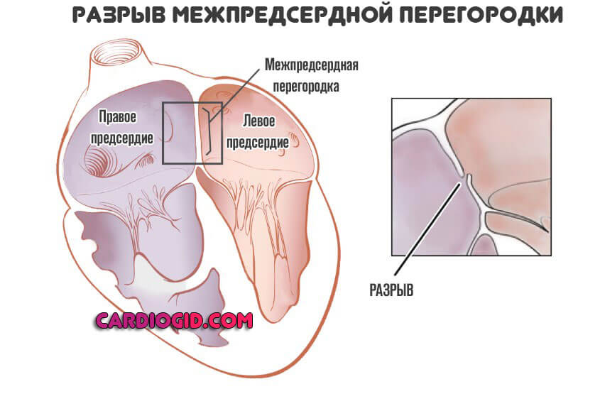 Зрелый разрыв. Разрыв межпредсердной перегородки. Разрыв сердечной перегородки. Разрыв межжелудочковой перегородки. Наружный разрыв сердца.