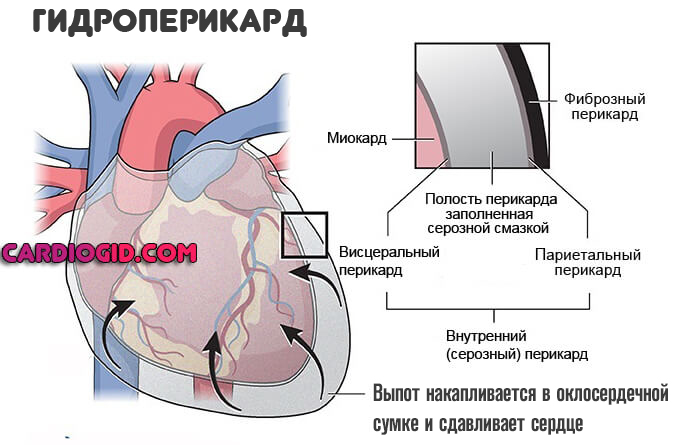 Тампонада сердца презентация