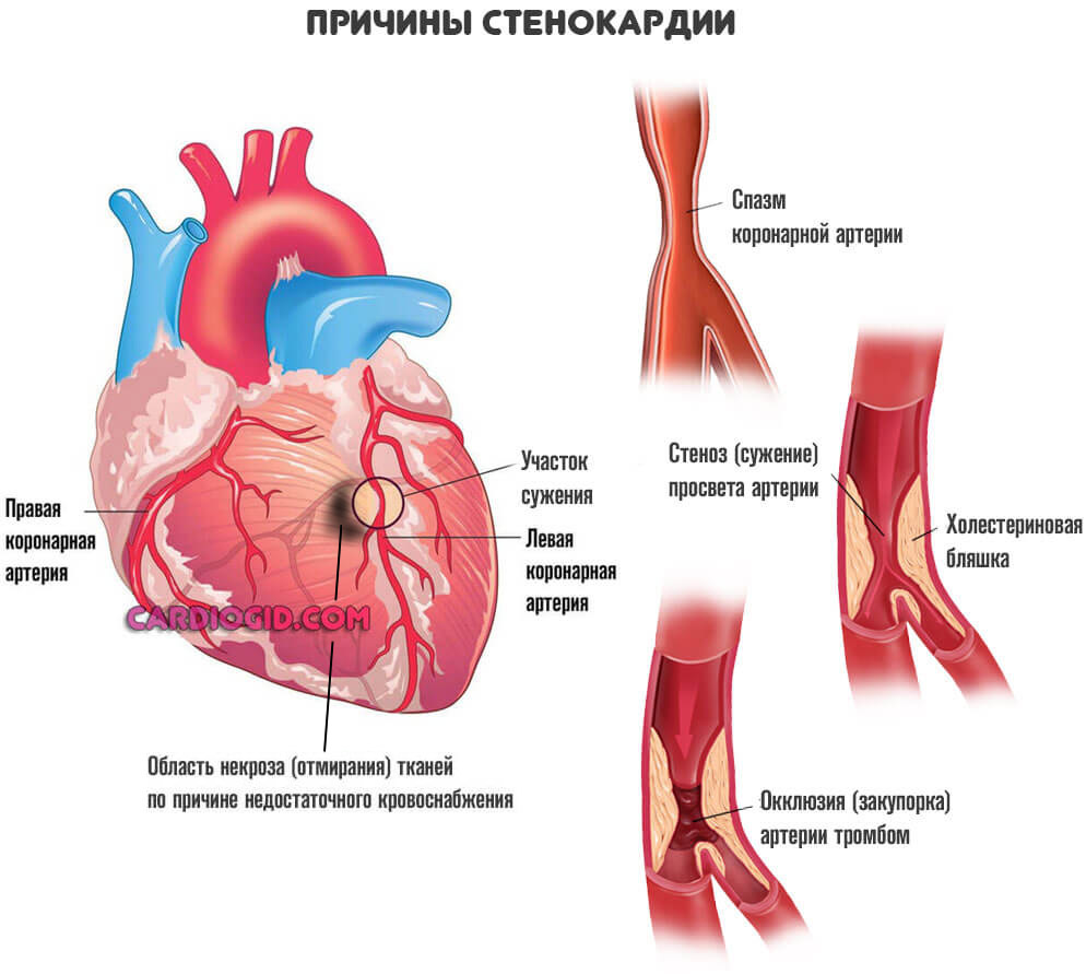 Стенокардия картинки для презентации