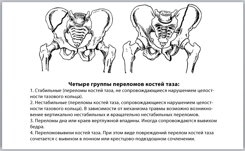 Закрытый перелом костей таза карта вызова