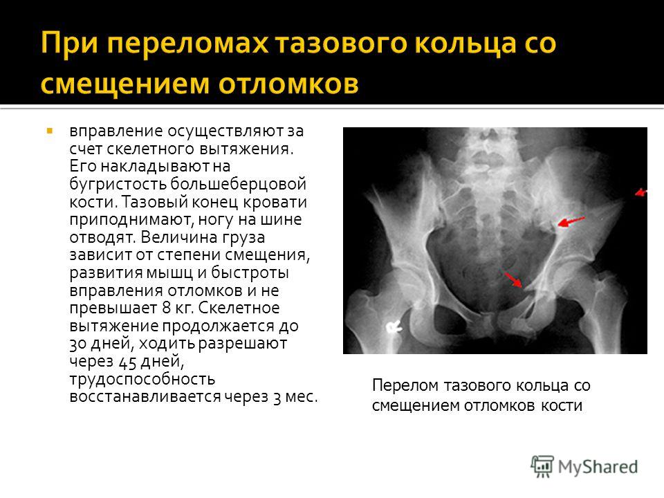 Закрытый перелом костей таза карта вызова