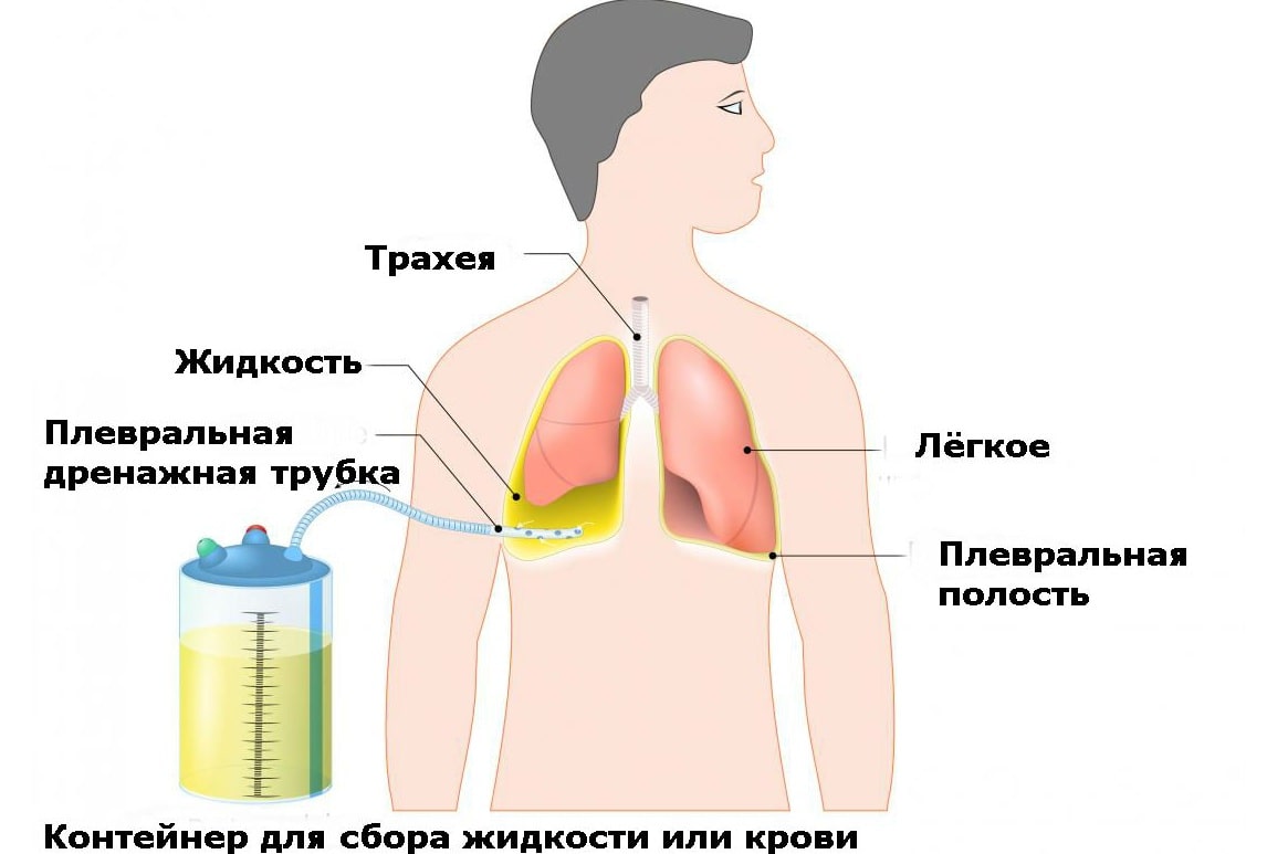 Вода в легких название. Пункция плевральной полости. Дренирование плевральной полости. Плевральная пункция технология. Пневмоторакс пункция плевральной полости. Плевральная пункция пневмоторакс.