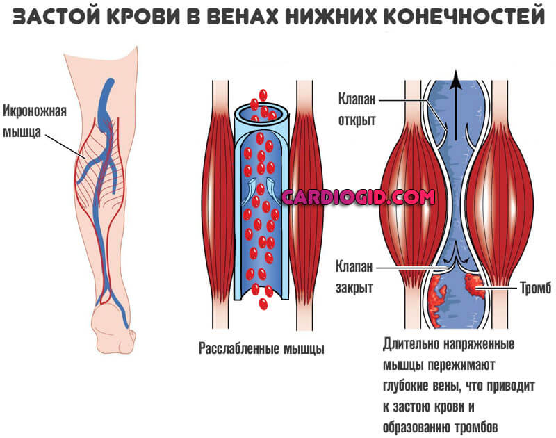 Тромбоз вен нижних конечностей карта смп