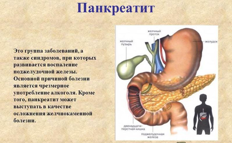 Заболеваний также данный. Панкреатит поджелудочной железы. При воспалении поджелудочной железы.