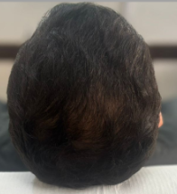 Caso 42 hombre después