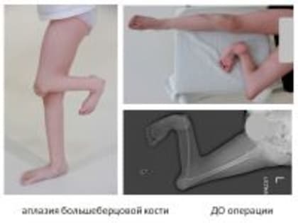 В Курганском Центре Илизарова спасают от ампутации девочку без кости левой голени