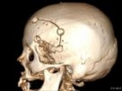 В Кургане нейрохирурги удалили пациентке две опухоли мозга