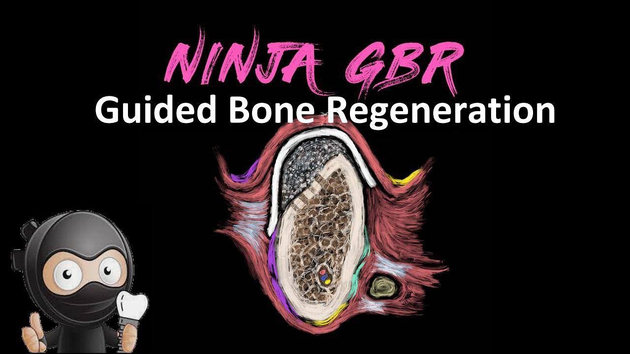 Implant Ninja, Ninja GBR