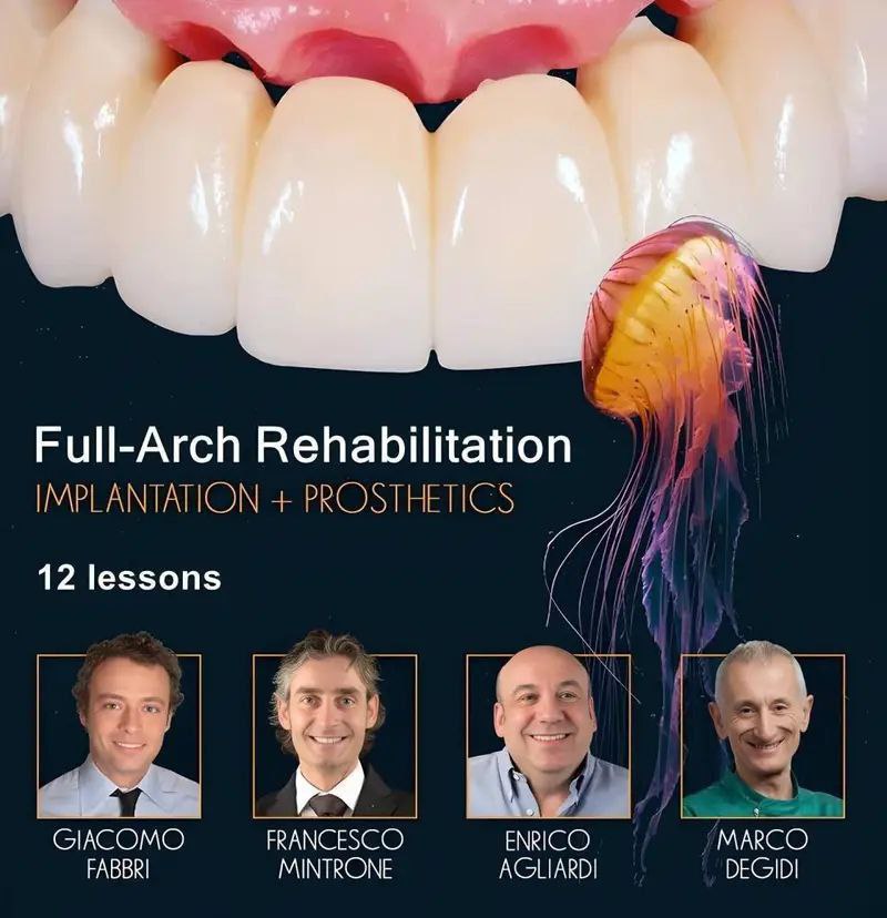 Full-Arch Rehabilitation, Implantation and Prosthetics