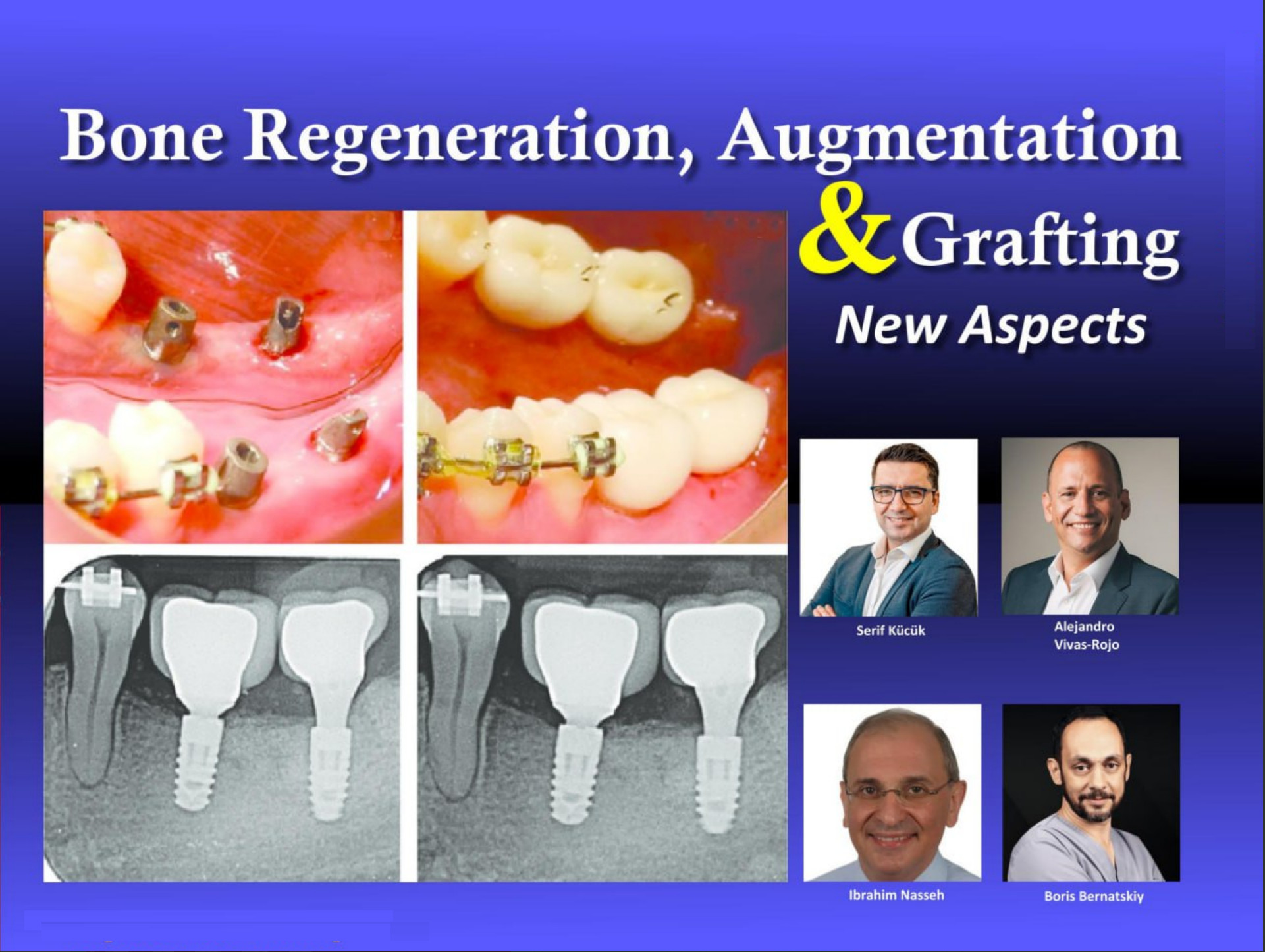 Cover of Bone Regeneration, Augmentation & Grafting, New Aspects