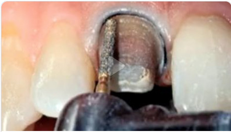 Cover of Classic Collection: Preparing Anterior Esthetic Crowns