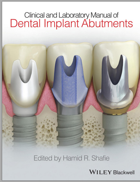 Cover of Ebook Clinical and Laboratory Manual of Dental Implant Abutments 1st Edition