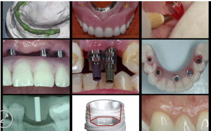Gidedental A-Z in Restorative Implant Dentistry (CME VIDEOS)