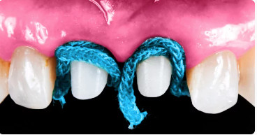 OHI-S Aesthetic Evolution