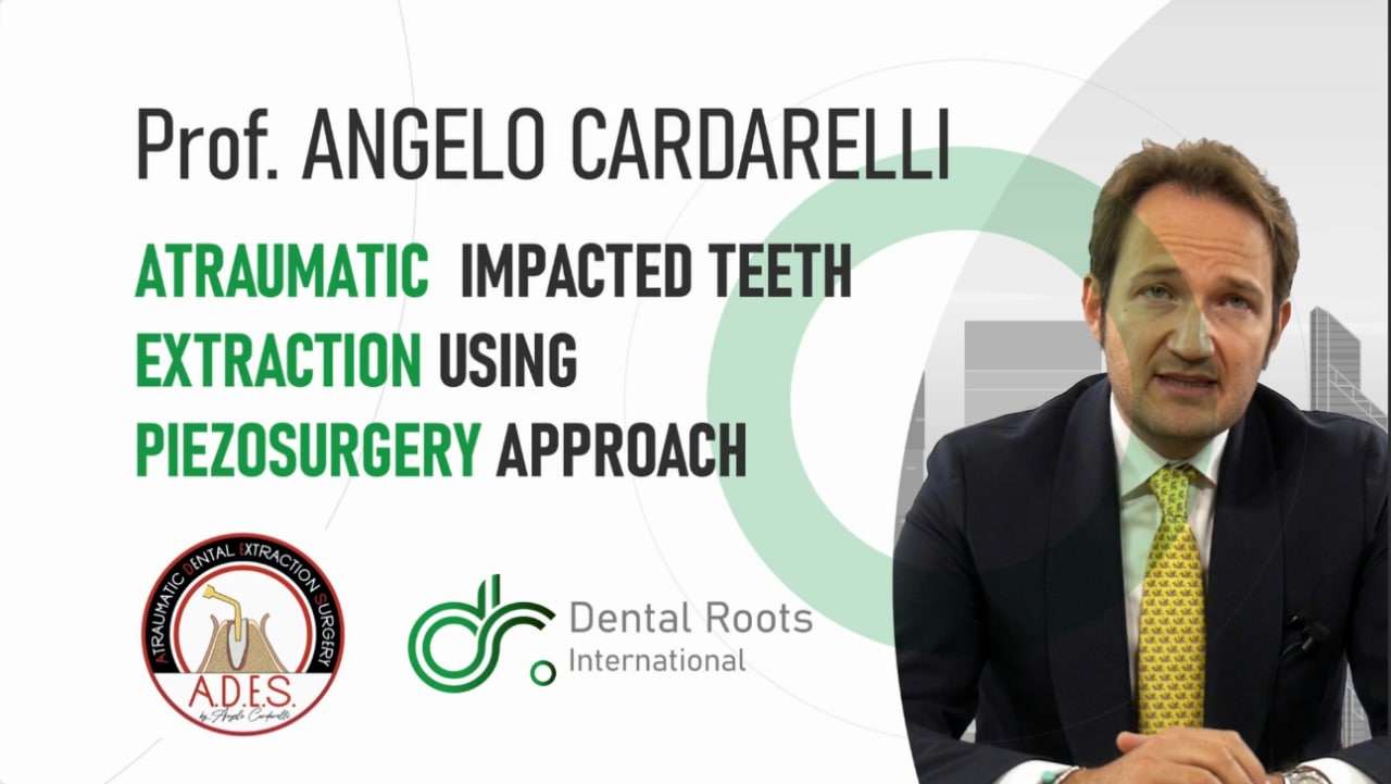 Cover of Piezosurgery Approach for Impacted Teeth Extraction – Angelo Cardarelli