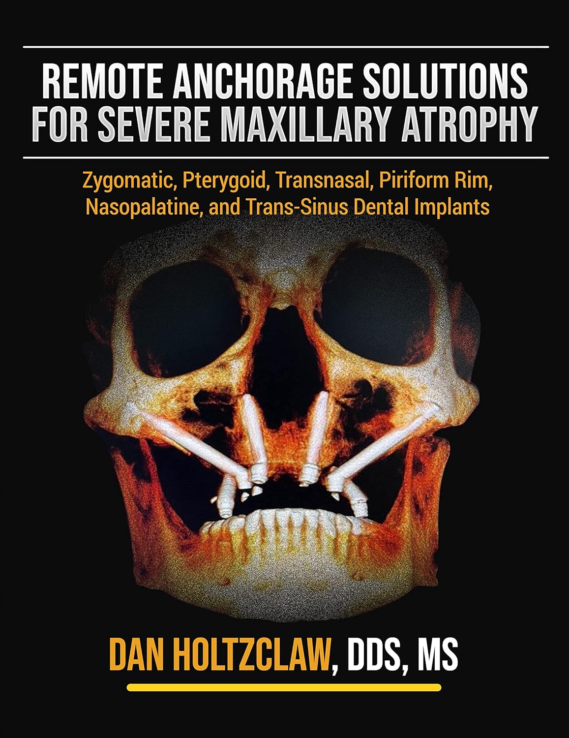 Cover of Remote Anchorage Solutions for Severe Maxillary Atrophy: Zygomatic Implants, Pterygoid Implants, Transnasal Implants, Piriform Rim Implants, Nasopalatine Implants, and Trans-Sinus Dental Implants Textbook Binding