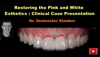 Restoring the Pink and White Esthetics: Clinical Case Presentation
