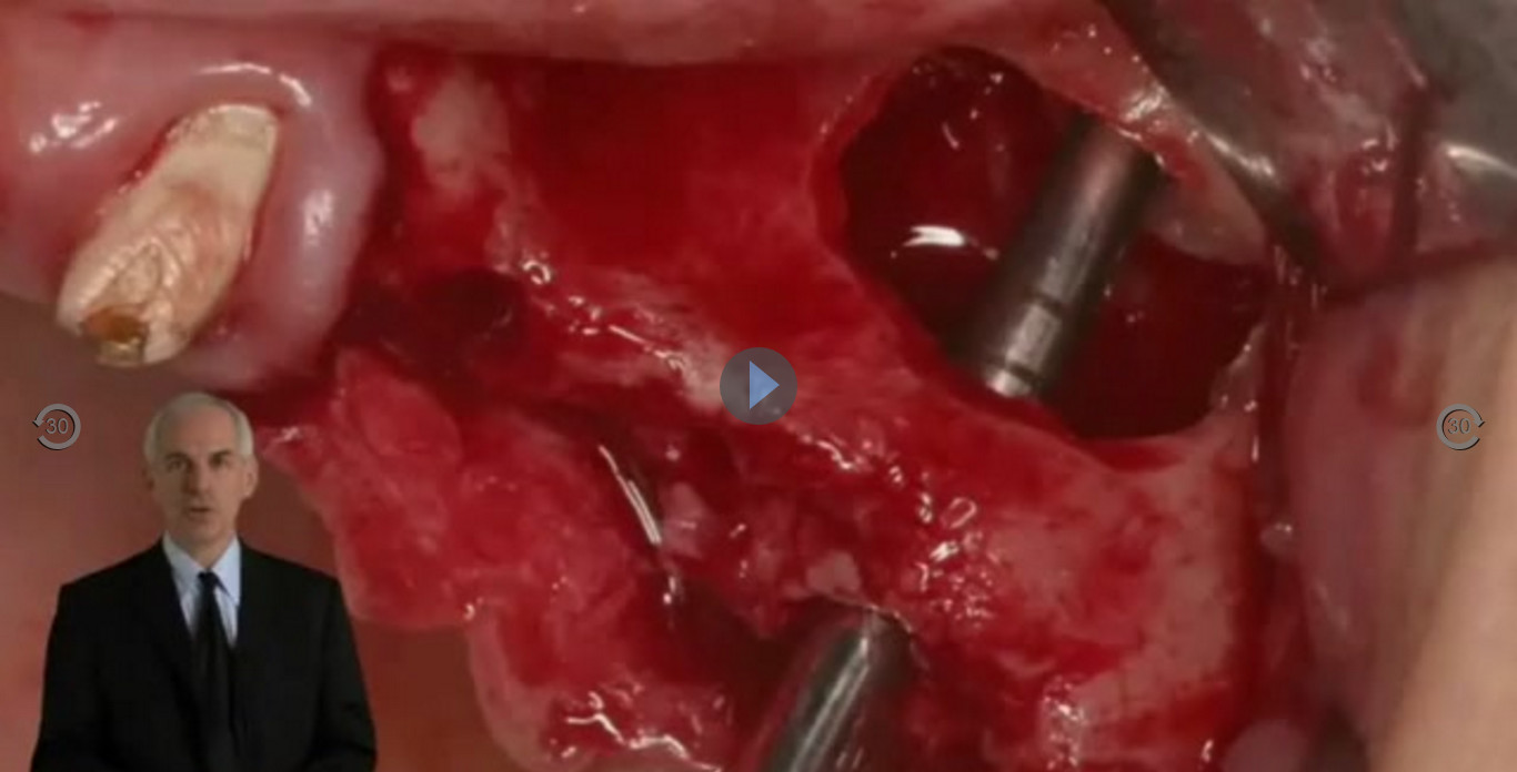 Cover of State of the Art in Sinus Augmentation – Current and Future Trends