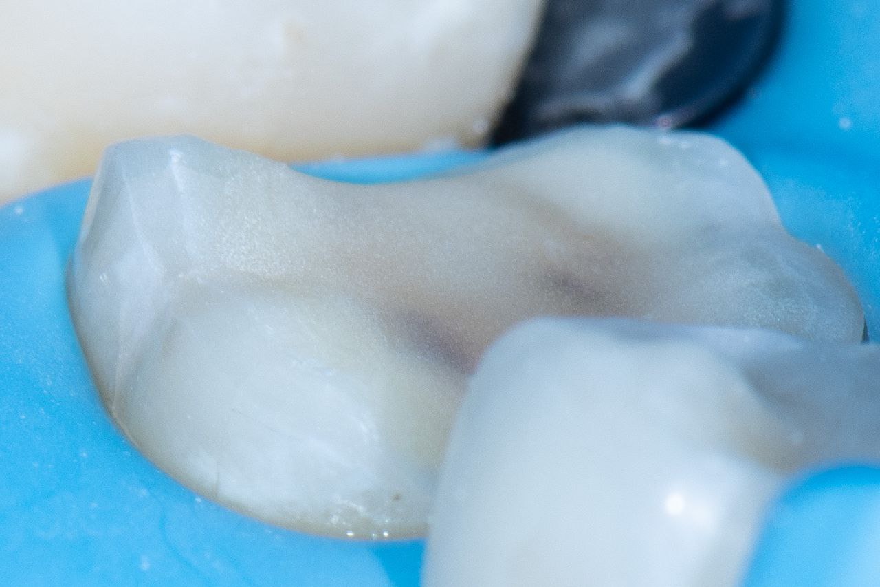 The Baard Institute Overlay, Onlay, & Advanced Adhesion