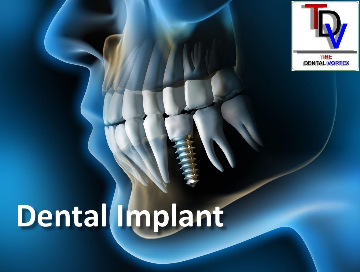 The Dental Vortex – Dental Implant