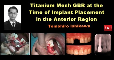 Titanium Mesh GBR at the Time of Implant Placement in the Anterior Region