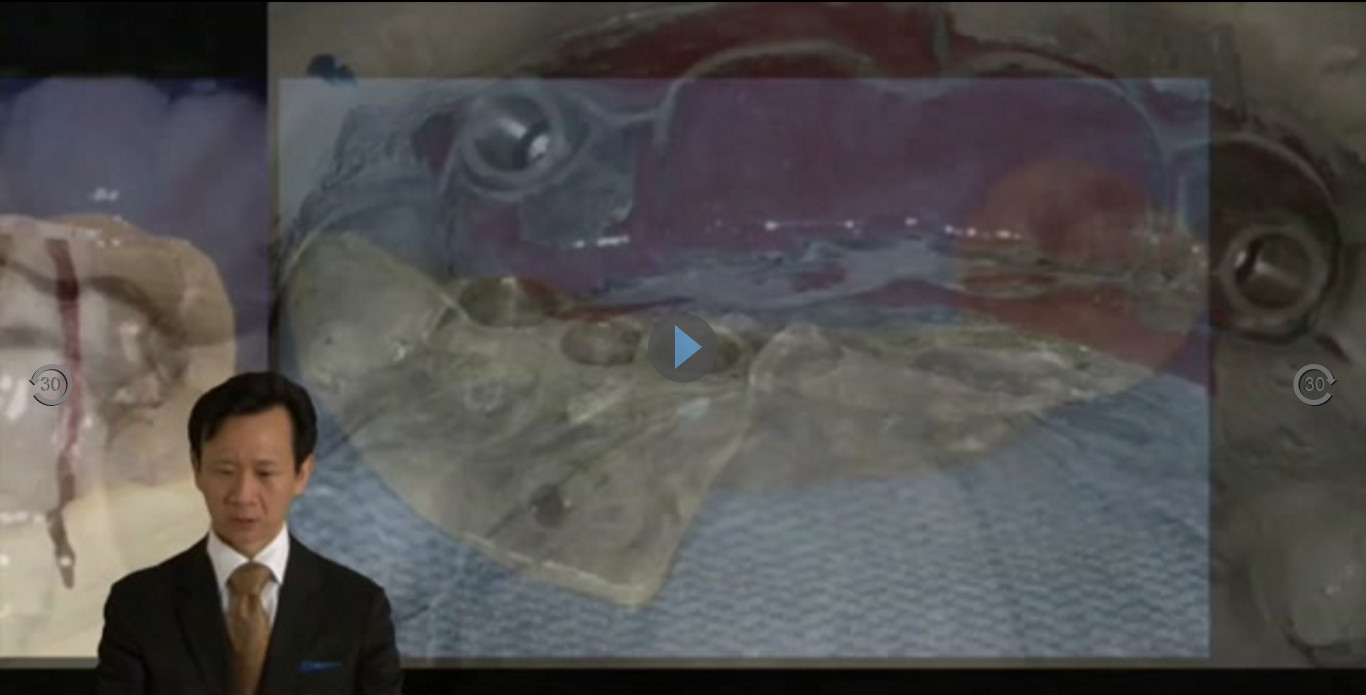 Why Guided Surgery (Part 1) – A Restorative Perspective