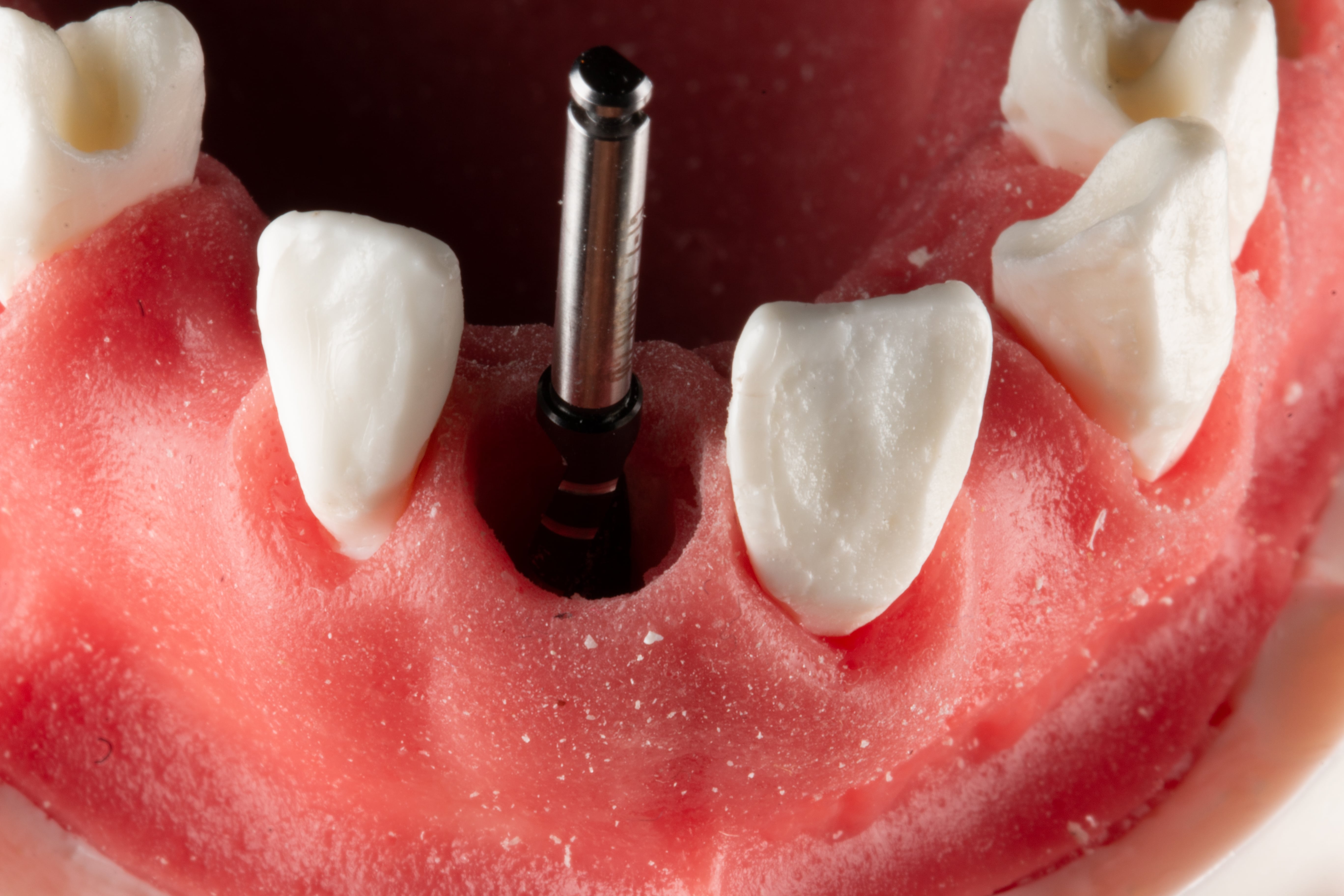 Anterior Implant Placement – Digital Dentistry Institute